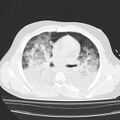Acute aspiration pneumonitis (Radiopaedia 33605-34703 Axial lung window 48).jpg