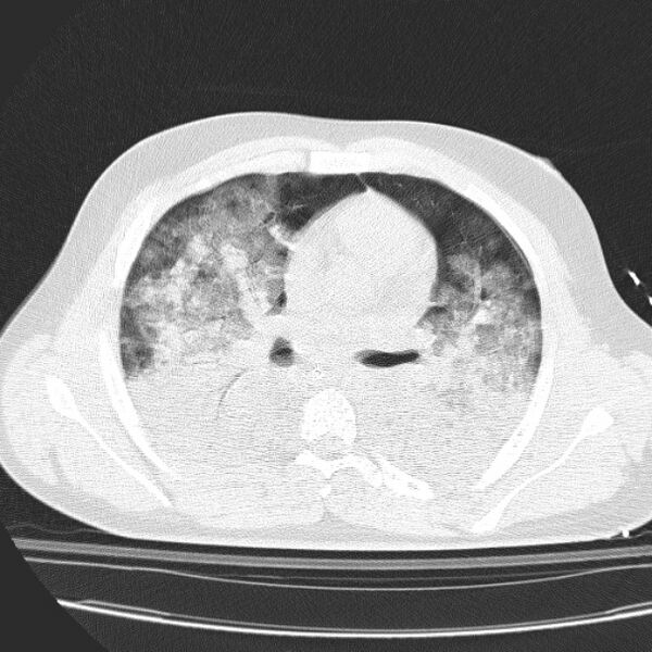 File:Acute aspiration pneumonitis (Radiopaedia 33605-34703 Axial lung window 48).jpg