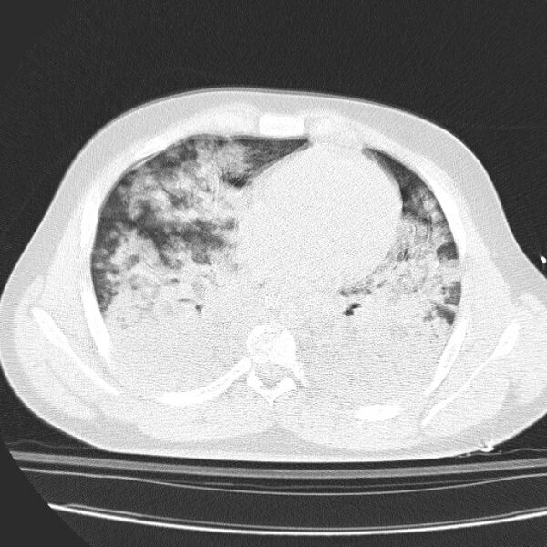File:Acute aspiration pneumonitis (Radiopaedia 33605-34703 Axial lung window 58).jpg