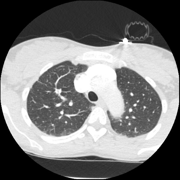 File:Acute chest syndrome - sickle cell disease (Radiopaedia 42375-45499 Axial lung window 54).jpg