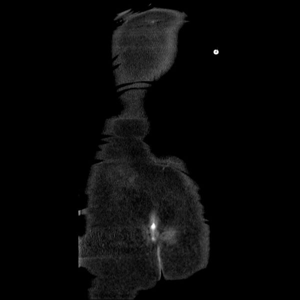 File:Acute cholecystitis and incidental left sided IVC (Radiopaedia 49352-54459 Coronal C+ portal venous phase 5).jpg