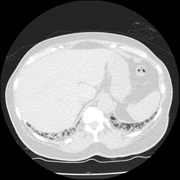 File:Acute interstitial pneumonitis (Radiopaedia 45404-49444 Axial lung window 90).jpg