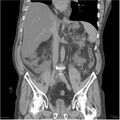 Acute pancreatitis (Radiopaedia 19135-19116 Coronal non-contrast 25).jpg