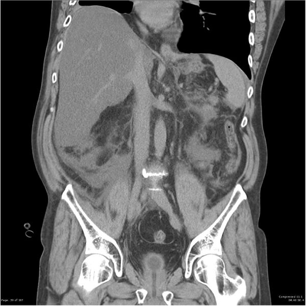 File:Acute pancreatitis (Radiopaedia 19135-19116 Coronal non-contrast 25).jpg