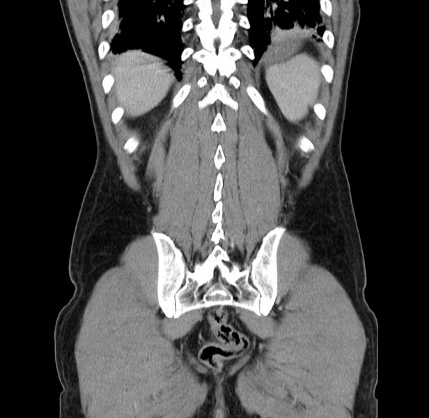 File:Acute pancreatitis (Radiopaedia 22572-22596 Coronal C+ portal venous phase 45).jpg
