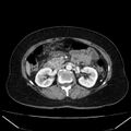 Acute pancreatitis - Balthazar C (Radiopaedia 26569-26714 Axial C+ arterial phase 38).jpg