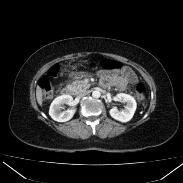 File:Acute pancreatitis - Balthazar C (Radiopaedia 26569-26714 Axial C+ arterial phase 38).jpg