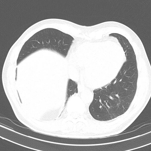 File:Acute pulmonary embolism (Radiopaedia 81677-95570 Axial lung window 35).jpg