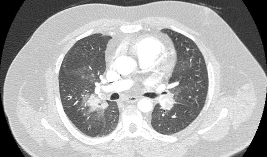 Acute pulmonary embolism with pulmonary infarcts (Radiopaedia 77688-89908 Axial lung window 51).jpg