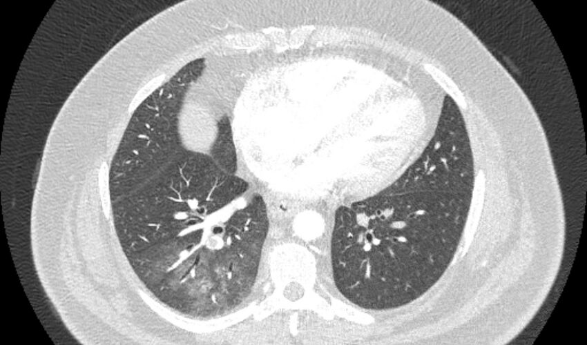 Acute pulmonary embolism with pulmonary infarcts (Radiopaedia 77688-89908 Axial lung window 82).jpg