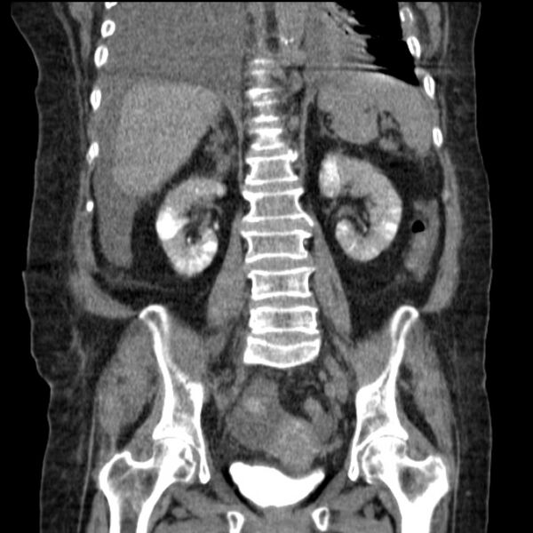 File:Acute tubular necrosis (Radiopaedia 28077-28334 D 55).jpg
