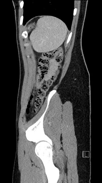 File:Acute uncomplicated appendicitis (Radiopaedia 61374-69304 Sagittal C+ portal venous phase 17).jpg