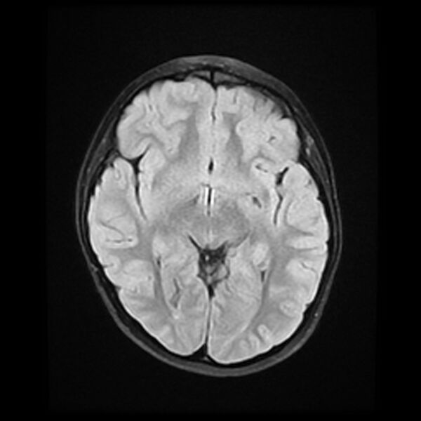 File:Adamantinomatous craniopharyngioma (Radiopaedia 77407-89529 Axial FLAIR 12).jpg