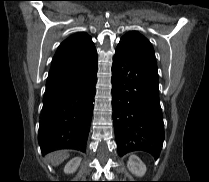File:Adenocarcinoma of the lung (Radiopaedia 44205-47803 Coronal C+ portal venous phase 76).jpg