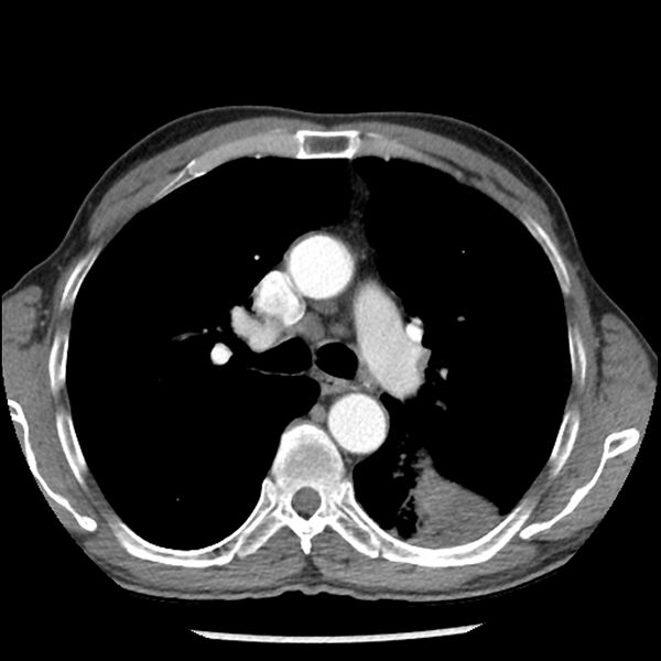 File:Adenocarcinoma of the lung - micropapillary predominant (Radiopaedia 42446-45563 Axial C+ portal venous phase 29).jpg