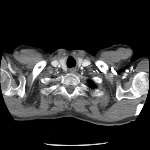 File:Adenocarcinoma of the lung - micropapillary predominant (Radiopaedia 42446-45563 Axial C+ portal venous phase 3).jpg
