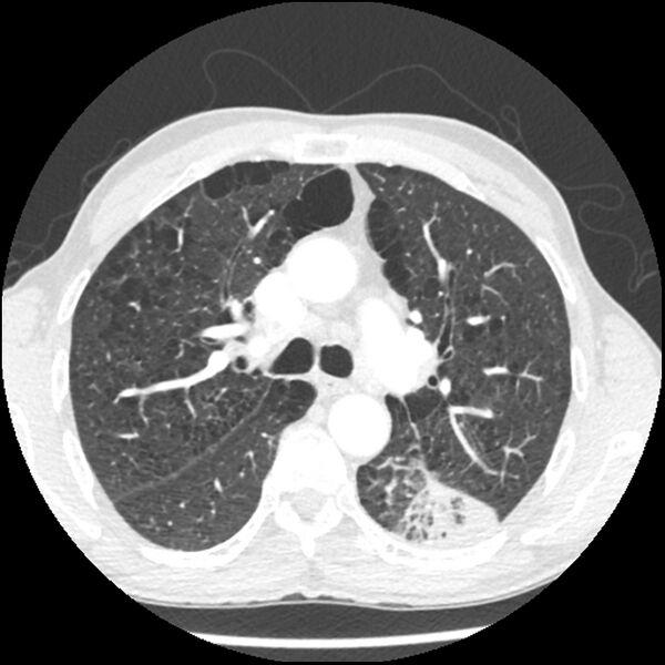 File:Adenocarcinoma of the lung - micropapillary predominant (Radiopaedia 42446-45563 C 18).jpg