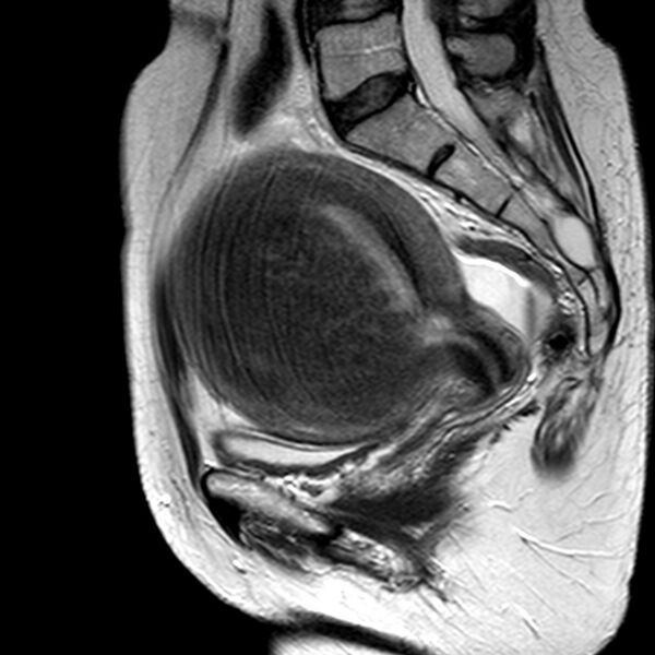 File:Adenomyoma of the uterus (huge) (Radiopaedia 9870-10438 Sagittal T2 8).jpg