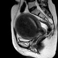 Adenomyoma of the uterus (huge) (Radiopaedia 9870-10438 Sagittal T2 9).jpg