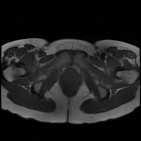 File:Adenomyosis on MRI (Radiopaedia 29328-29780 Axial T1 11).jpg