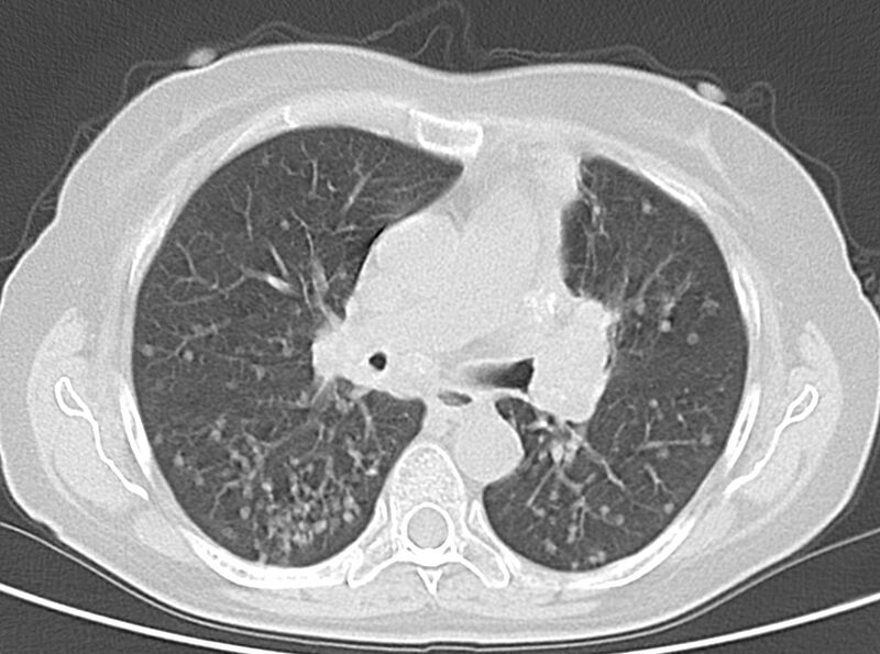 File:Adenosquamous lung carcinoma (Radiopaedia 22035-22030 lung window 30).jpg