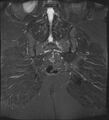 Adnexal multilocular cyst (O-RADS US 3- O-RADS MRI 3) (Radiopaedia 87426-103754 Coronal T2 fat sat 27).jpg