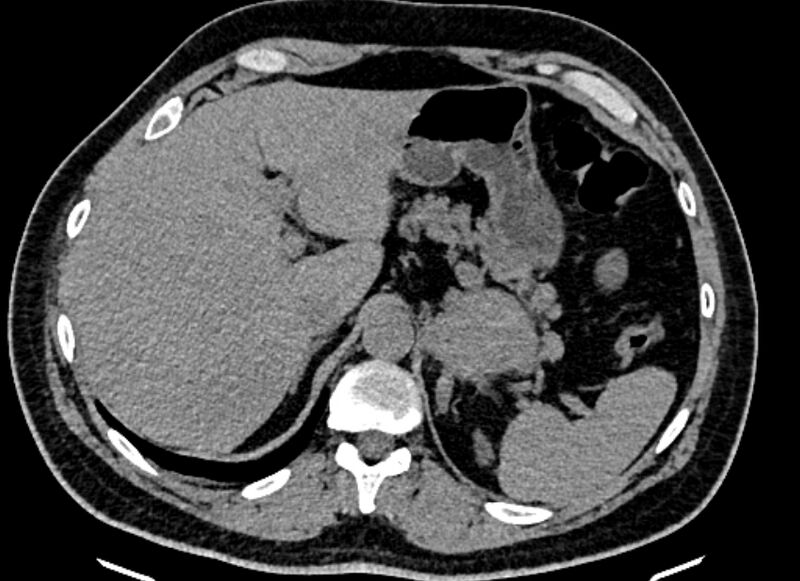 File:Adrenal metastases (Radiopaedia 73082-83791 Axial non-contrast 41).jpg
