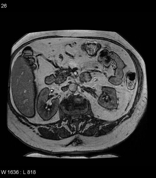 File:Adrenal myelolipoma (Radiopaedia 6765-7961 Axial T1 out-of-phase 26).jpg