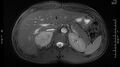 Adrenal pheochromocytoma (Radiopaedia 35133-36730 Axial T2 fat sat 4).jpg