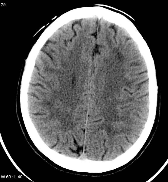 File:Aicardi syndrome (Radiopaedia 5353-7116 Axial non-contrast 26).jpg