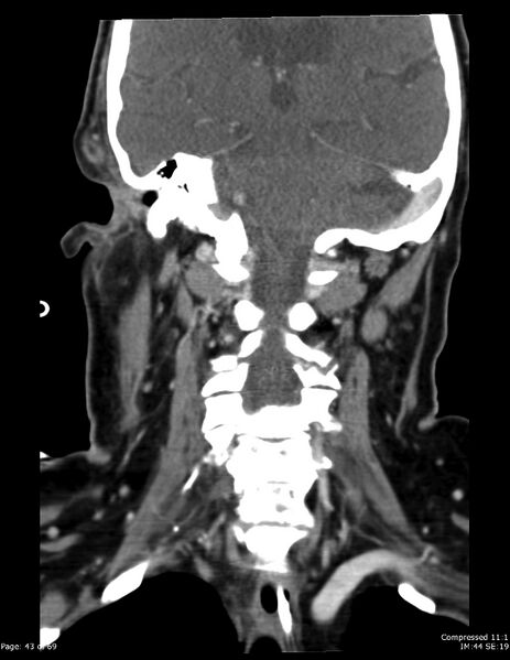 File:Airway narrowing post surgical drainage of neck abscess (Radiopaedia 28885-29206 B 34).jpg