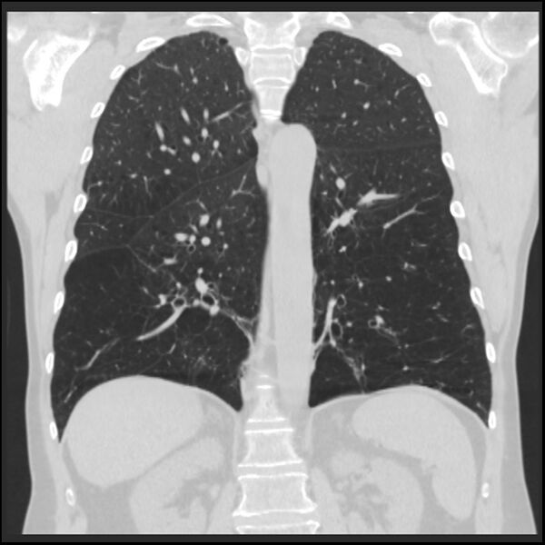 File:Alpha-1-antitrypsin deficiency (Radiopaedia 40993-43722 Coronal lung window 68).jpg