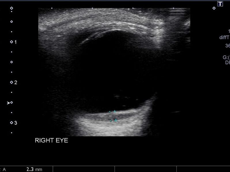 File:Amelanotic retinal melanoma (Radiopaedia 60667-68413 B 1).jpg