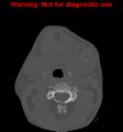 Ameloblastoma (Radiopaedia 13276-13280 Axial non-contrast 3).jpg