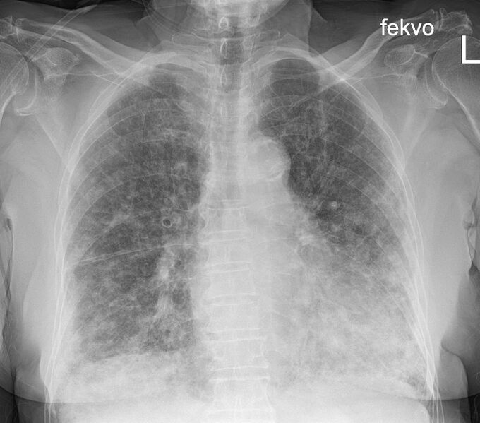 File:Amiodarone-induced pulmonary fibrosis (Radiopaedia 82355-96459 Frontal 1).jpg