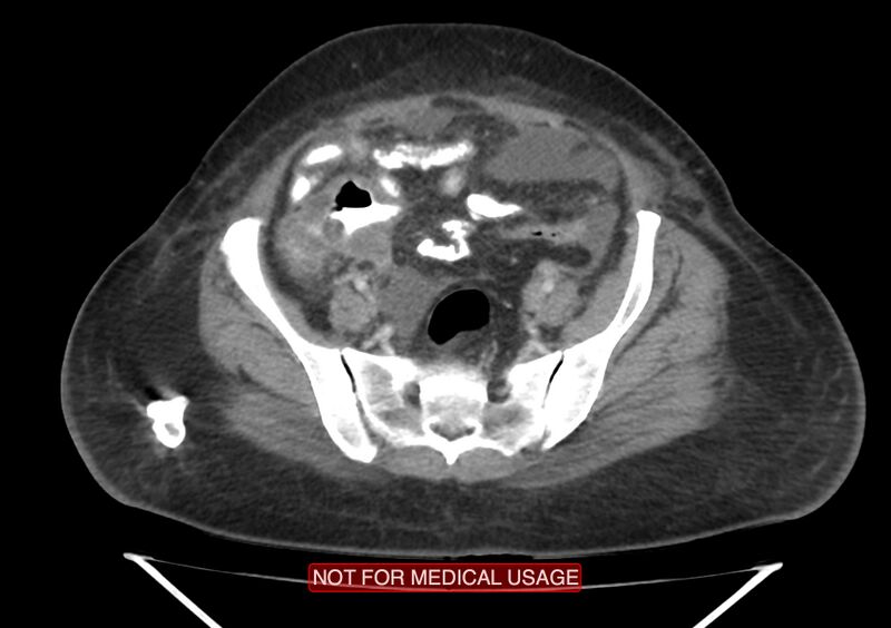 File:Amoebic enterocolitis with liver abscess (Radiopaedia 35100-36609 A 64).jpg
