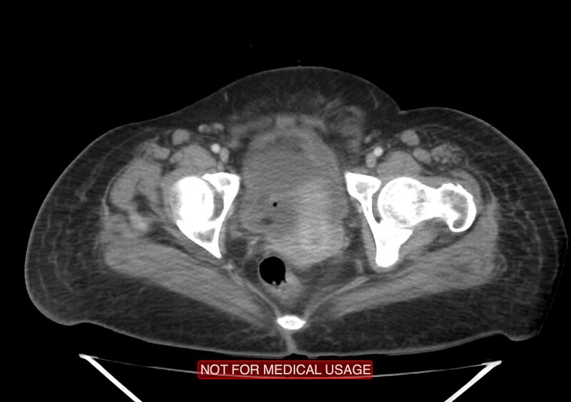 File:Amoebic enterocolitis with liver abscess (Radiopaedia 35100-36609 A 78).jpg