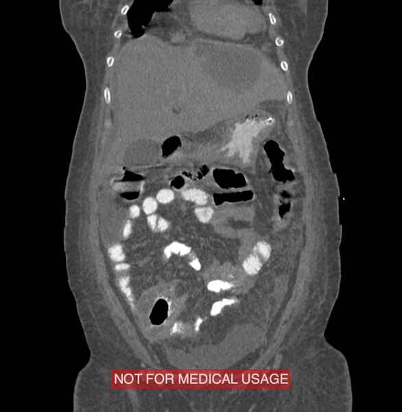 File:Amoebic enterocolitis with liver abscess (Radiopaedia 35100-36609 B 41).jpg