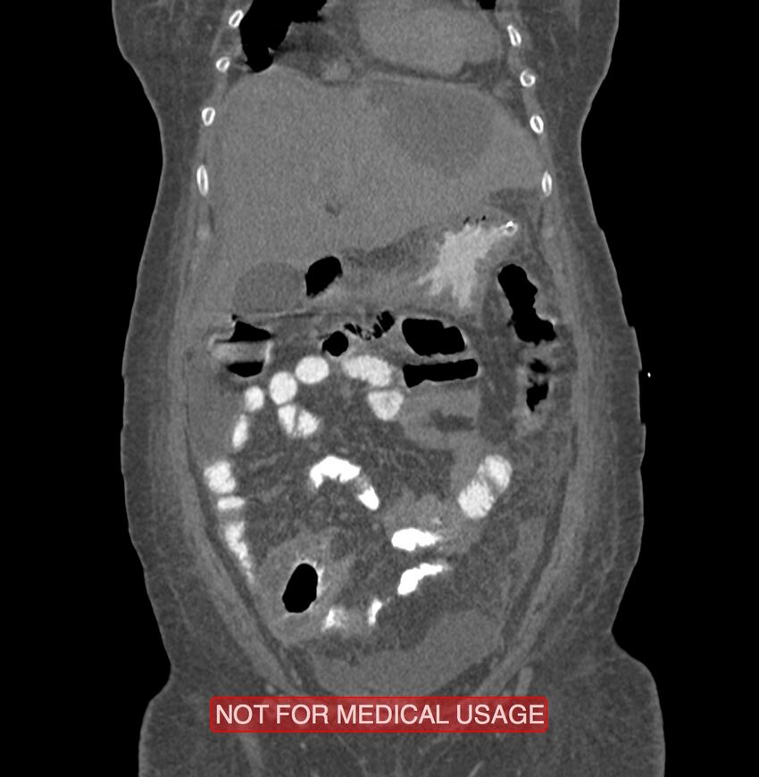 Amoebic enterocolitis with liver abscess (Radiopaedia 35100-36609 B 41).jpg