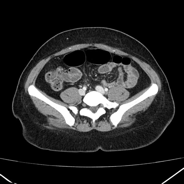 File:Ampullary tumor (Radiopaedia 22787-22816 C 47).jpg