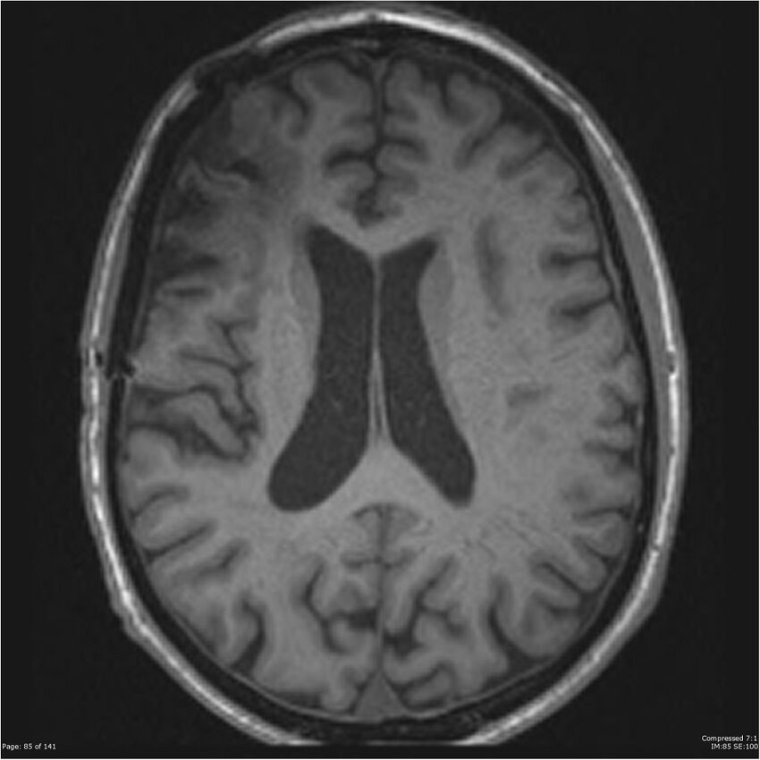 Anaplastic meningioma with recurrence (Radiopaedia 34452-35788 Axial T1 83).jpg