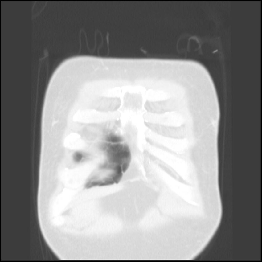Angioinvasive aspergillosis (Radiopaedia 43957-47466 Coronal lung window 86).jpg