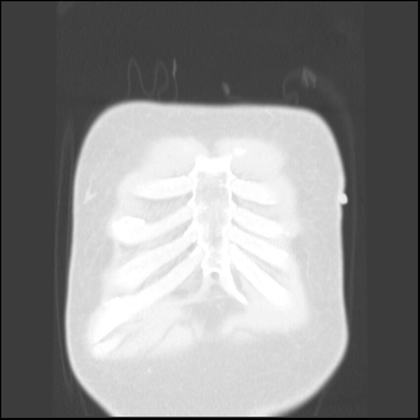 Angioinvasive aspergillosis (Radiopaedia 43957-47466 Coronal lung window 88).jpg
