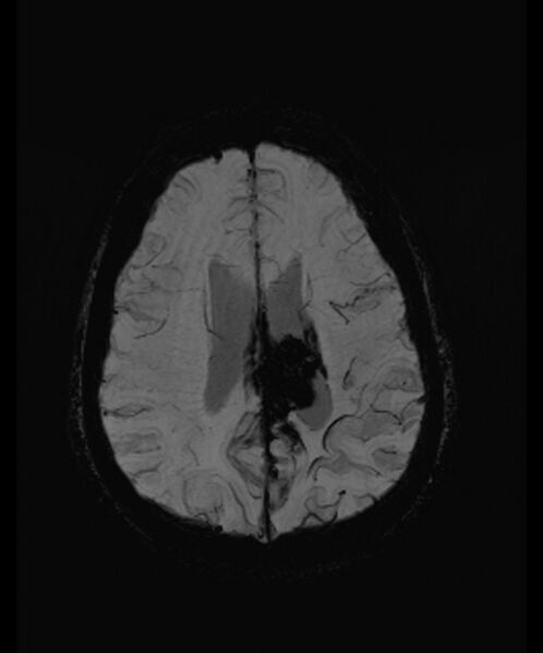 File:Angiomatous meningioma (Radiopaedia 79459-92579 E 46).jpg
