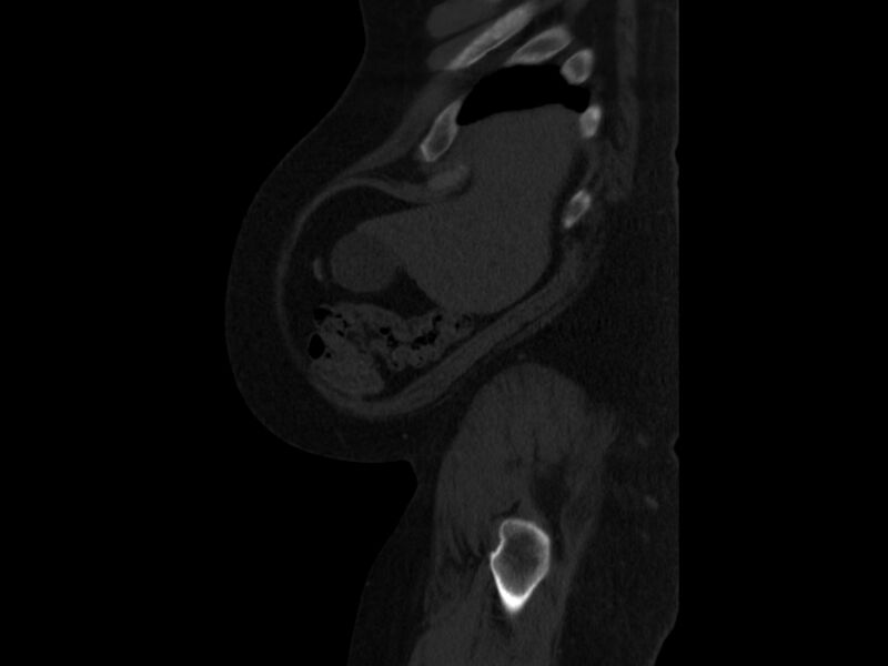 File:Ankylosing spondylitis (Radiopaedia 44609-48357 Sagittal bone window 1).jpg