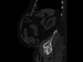 Ankylosing spondylitis (Radiopaedia 44609-48357 Sagittal bone window 87).jpg