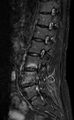Ankylosing spondylitis - Andersson lesion (Radiopaedia 81878-95838 Sagittal STIR 9).jpg