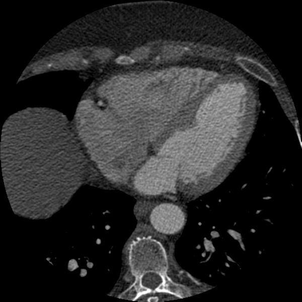 File:Anomalous origin of left circumflex artery from right coronary sinus (Radiopaedia 72563-83117 B 121).jpg