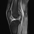 Anterior cruciate ligament full thickness tear (Radiopaedia 66268-75467 Sagittal PD fat sat 14).jpg