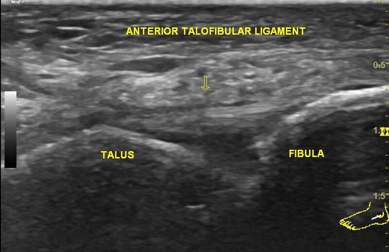 File:Anterior inferior tibiofibular ligament injury (Radiopaedia 79703).jpg